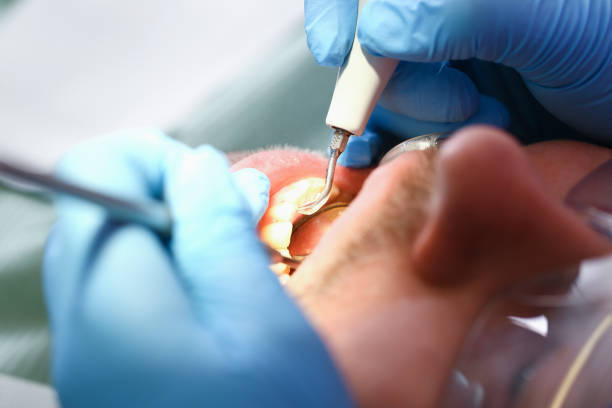 Best Urgent Care for Lost Fillings or Crowns in Walkerton, IN