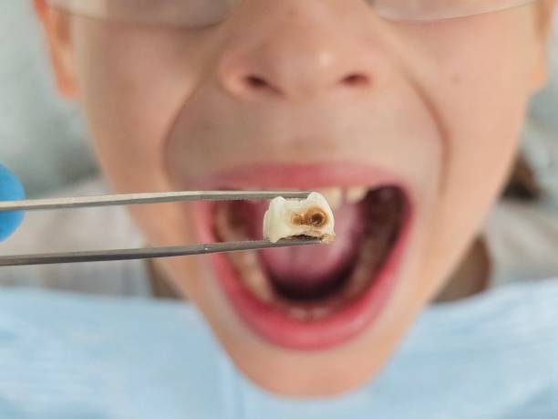 Best Emergency Gum Treatment in Walkerton, IN